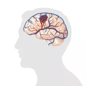 Brain AVM