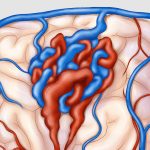 Brain/Spine AVM - Toronto Neurovascular Group