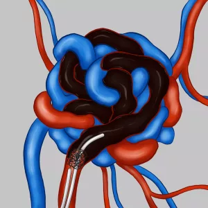 Face AVM Embolism