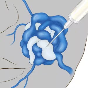 Face VVM injection