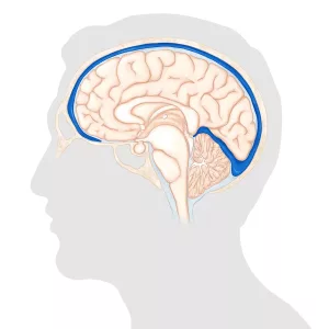 Hypotension