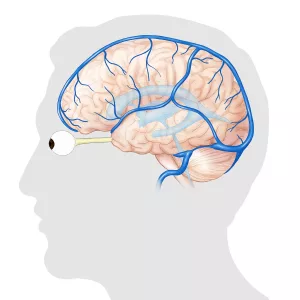 Brain Hypertension
