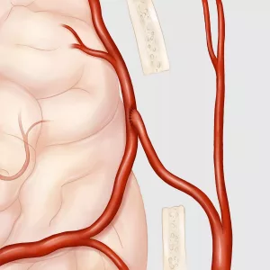 An illustrated image of a Moyamoya
