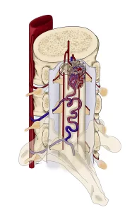 Spinal AVM